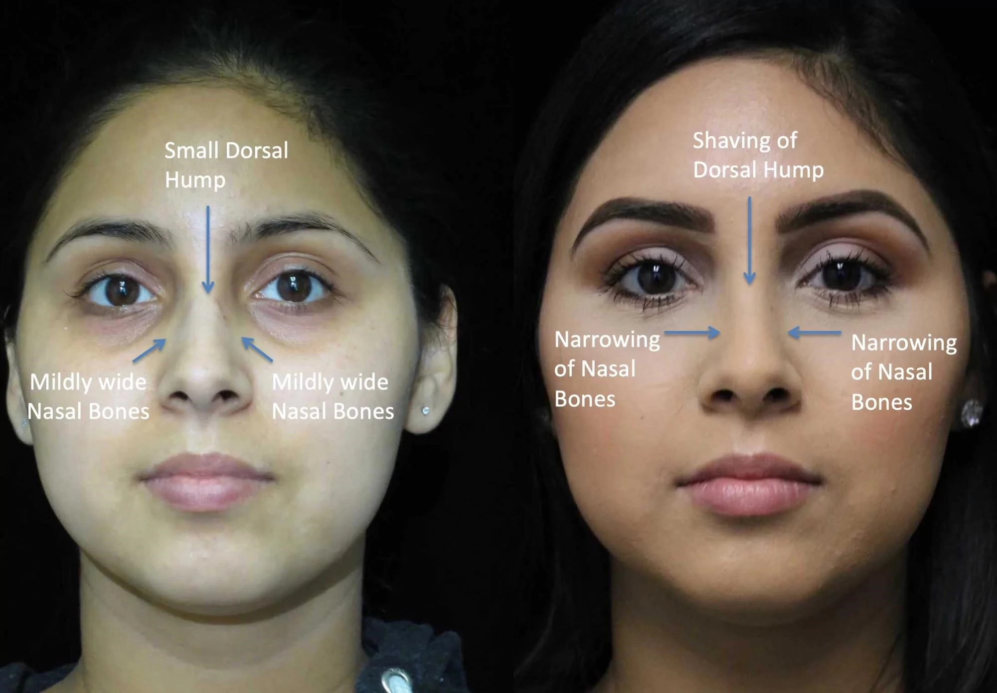 rhinoplasty surgery