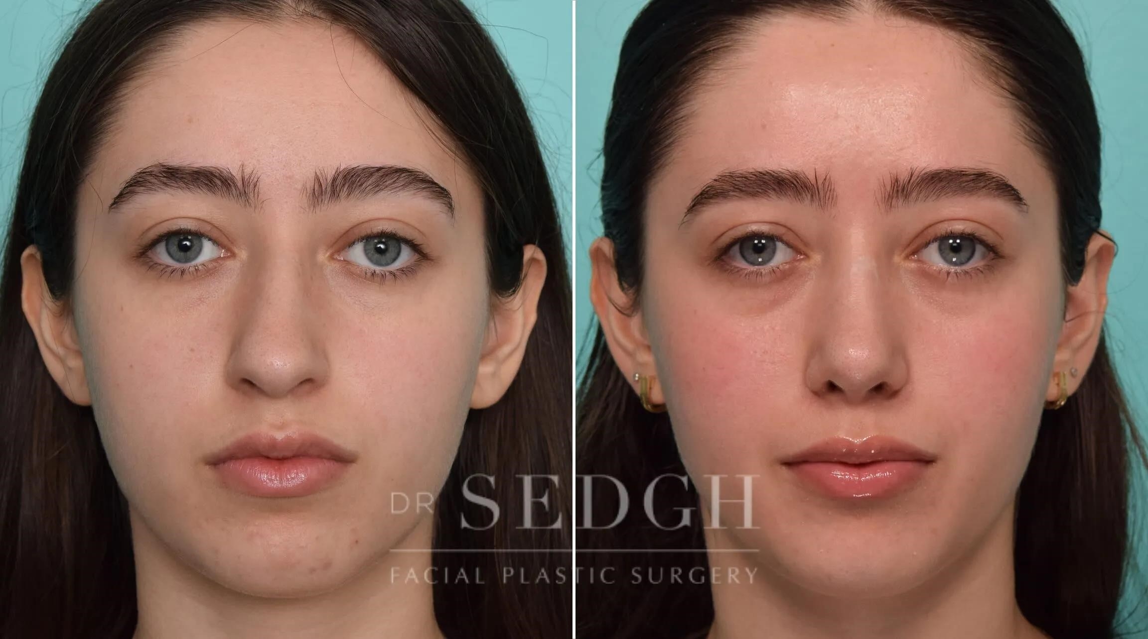 rhinoplasty surgery