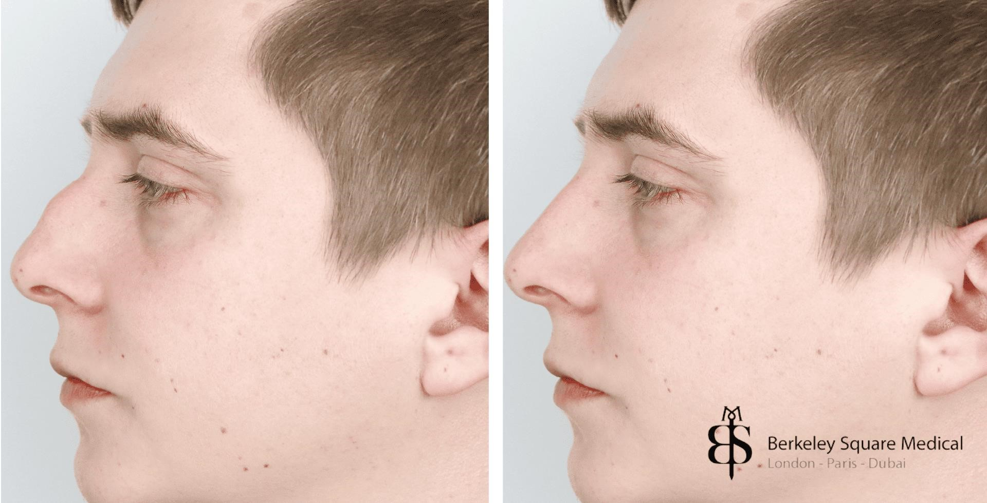 rhinoplasty surgery